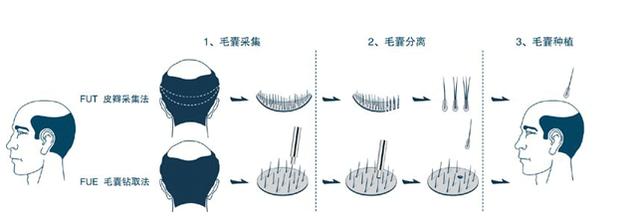 植发常见问题