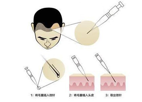 微针种植