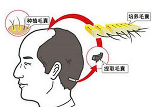 发际线种植