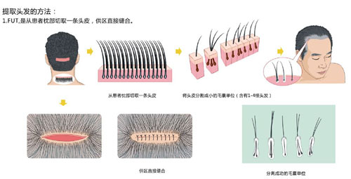 植发靠谱吗?